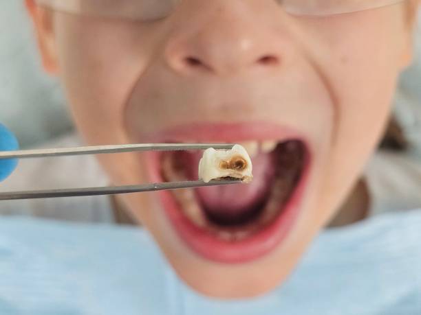 Best Emergency Dental Care for Abscessed Tooth in Port Townsend, WA